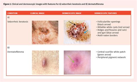 Melanoma Dermoscopy