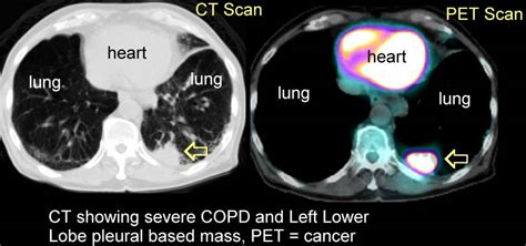 Xrays and CT Scans of Lung Cancer