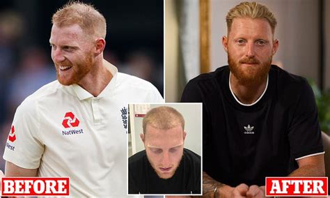 Ben Stokes opens up on how his battle with hair loss was 'getting too ...