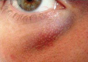 White Dots under Eyes – Little White Bumps, Circles Under Eyes & How to Get Rid of White Dots ...