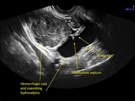 Hemorrhagic ovarian cysts: One entity with many appearances | MDedge ObGyn