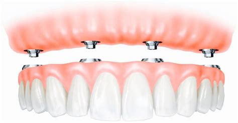 How Much Do Dentures Cost? - Olds Denture & Implant Centre