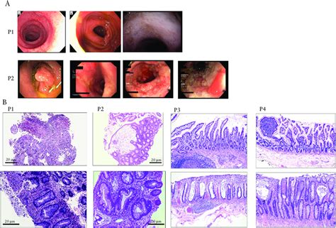 Abnormal colonoscopy and histology of biopsies from ileum and colon of... | Download Scientific ...