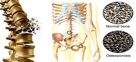 Air pollution causes weak bones, fractures