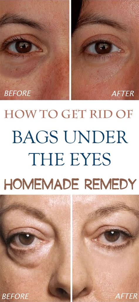 Homemade remedies for bags under eyes - HEALTH AND DIY IDEAS