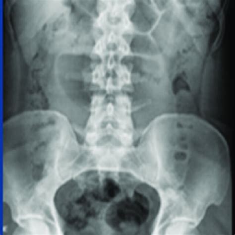 X-Ray abdomen showing centrally dilated loops. | Download Scientific ...