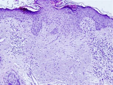 Histology (H/E ×10) showing dermal fibrosis without any evidence of ...