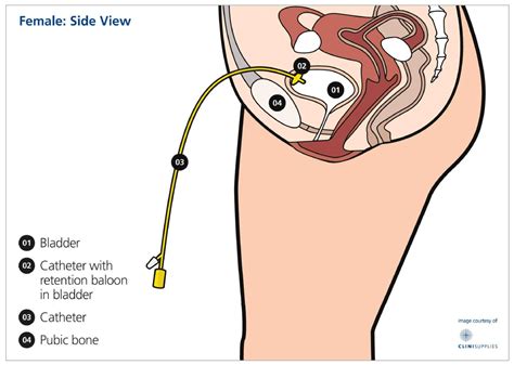 You and your catheter — Urology Associates