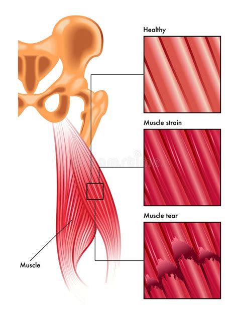 Muscle Strain And Tear Stock Photo - Image: 62932917