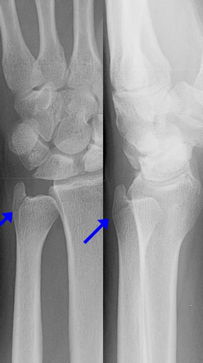 Wrist Case 3 ED Management: Orthopedic Teaching: Feinberg School of ...