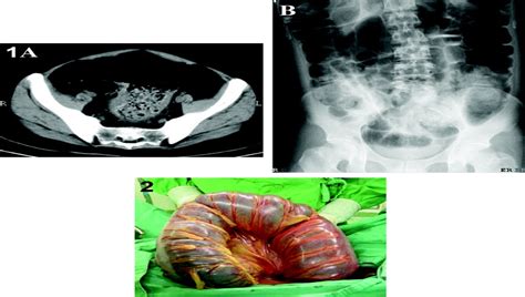 Toxic Megacolon With Abdominal Compartment Syndrome : Journal of Trauma ...