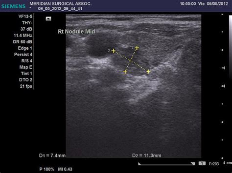 Thyroid Biopsy by Alexander Shifrin, MD | www.Thyroid-Biopsy.com