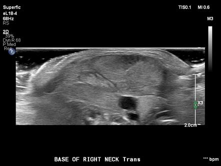 Fibromatosis coli | Image | Radiopaedia.org