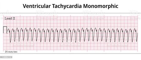 Monomorphic Ventricular Tachycardia Ecg Monomorphic Vt 8 Second Electrocardiogram Paper Stock ...