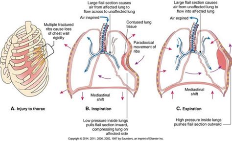 Chest Trauma/Flail Chest/Rib Fractures Flashcards | Quizlet