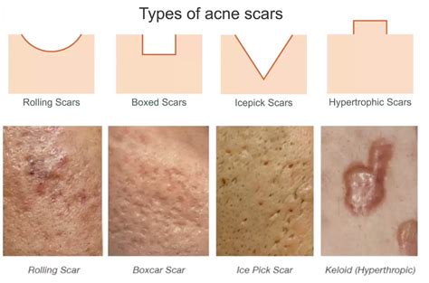 Acne Scars: Types of Acne Scarring and Ideal Treatments