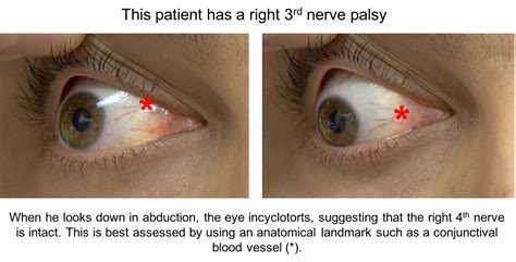 Fourth nerve palsy – Case-Based Neuro-Ophthalmology