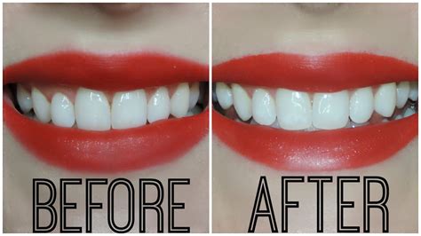 Crest 3d White Strips Before And After Pictures