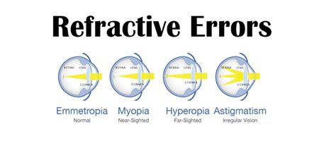 Jenks Eye Doctor: Refractive Errors | Insight Eyecare