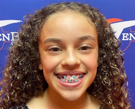 Color Braces: See Why Kids Love Their Fun Colorful Smiles