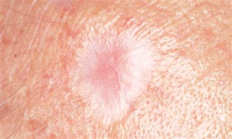 White Spots On Skin Cancer