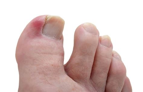 Blister On Big Toe Diabetes - DiabetesWalls