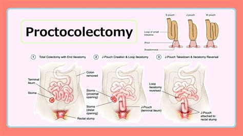 proctocolectomy - YouTube