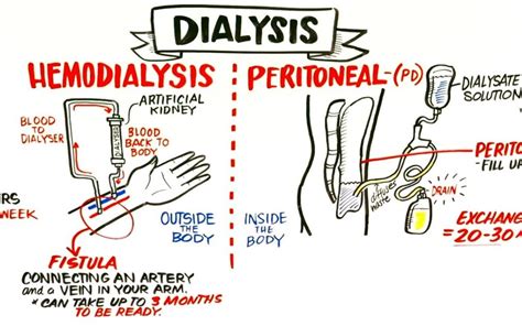 How Hemodialysis and Peritoneal Dialysis Work | Peritoneal dialysis ...