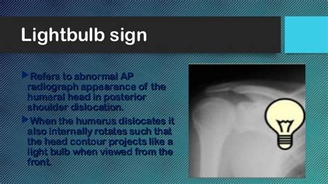 03. shoulder dislocation