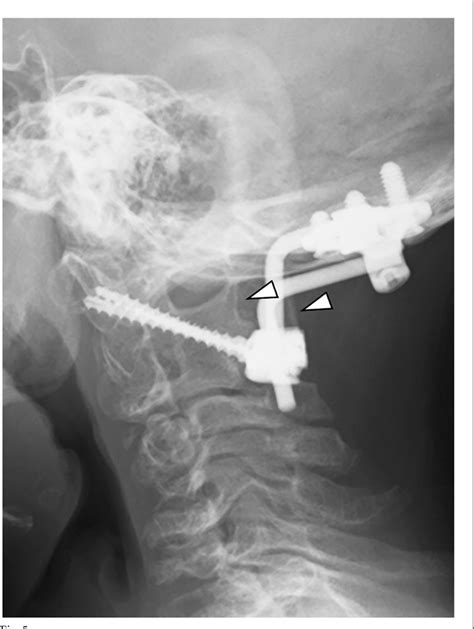 Figure 1 from Surgical Treatment of Chondrodysplasia Punctata Tibial-Metacarpal Type Until ...