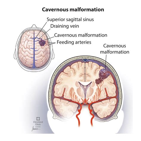 Cavernous Hemangioma: Symptoms, Treatment & Causes