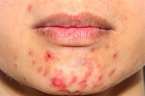 Acne excoriée (des jeunes filles) | ZGT Helon - Zorg voor uw huid