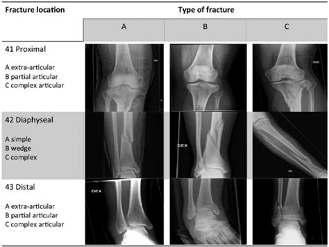 Tibial Plateau Fracture Ao Classification