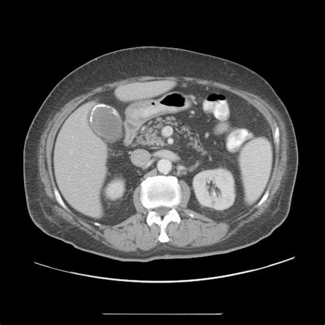 Porcelain gallbladder - wikidoc