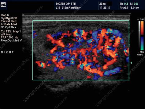 Inflamed lymph node, Doppler ultrasound - Stock Image - M200/0176 - Science Photo Library