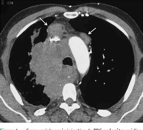 [Small-cell lung carcinoma: CT imaging features]. | Semantic Scholar