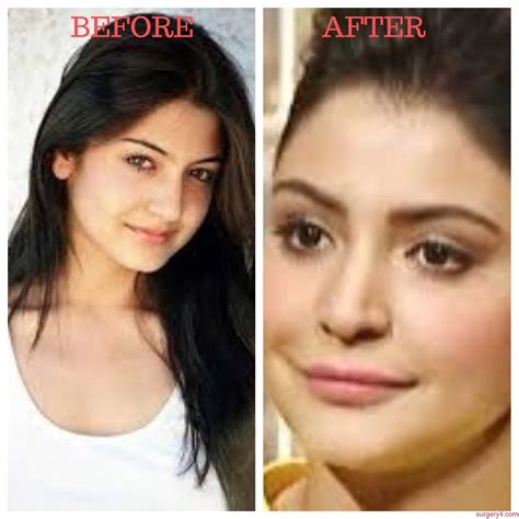 Anushka Sharma Lip Job Photos [Before & After] ⋆ Surgery4