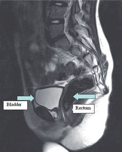 Absence of the uterus in the MRI scan. | Download Scientific Diagram