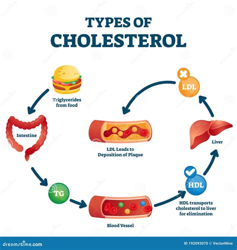 Types of Cholesterol Educational Cycle Scheme from Fatty Food To LDL Artery Stock Vector ...