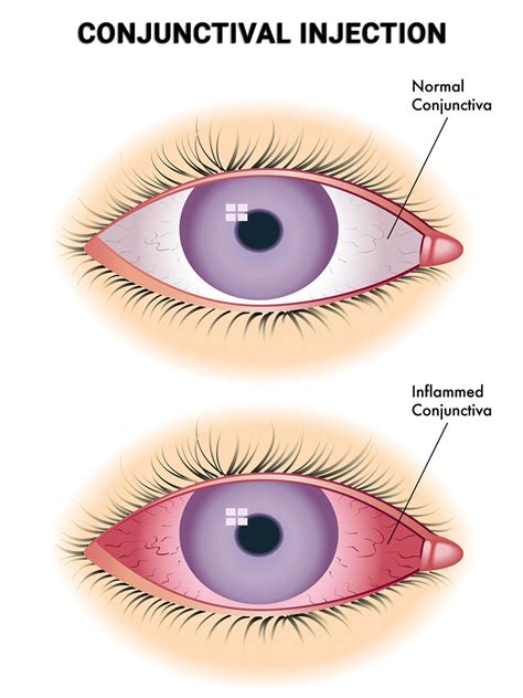 Conjunctival Injection in NYC - Vitreous Retina Macula Consultants of ...