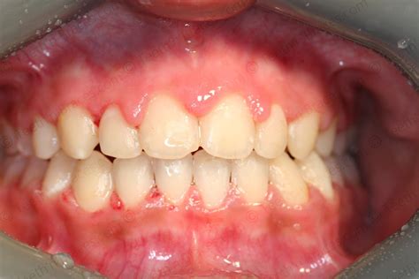 Case 36: Protruded anterior Teeth | Teeth N Braces