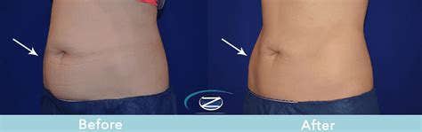 Coolsculpting Abdomen Before & After #3 - Zcosmetic Health