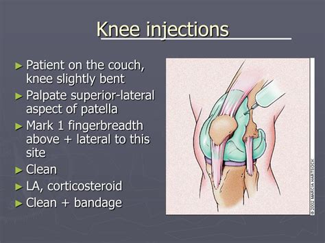 PPT - Steroid Joint injections PowerPoint Presentation, free download - ID:287025