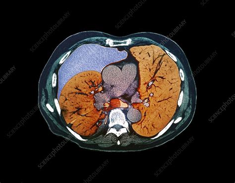 Pneumothorax, CT scan - Stock Image - C013/2179 - Science Photo Library