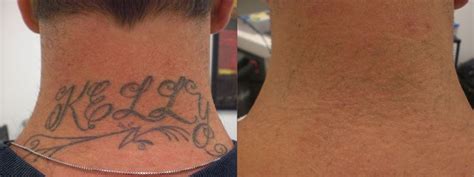 Before & After Images of LaserAway Treatments | LaserAway | Tattoo ...