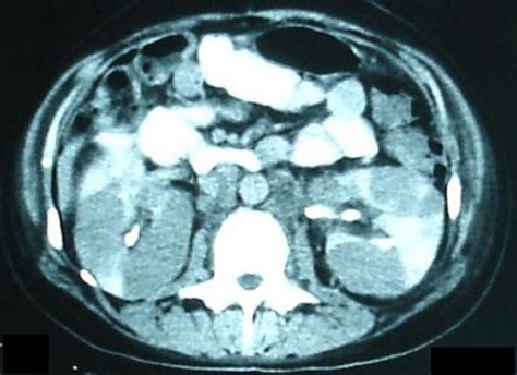 CT scan of the abdomen showing enlarged retroperitoneal lymph nodes and... | Download Scientific ...