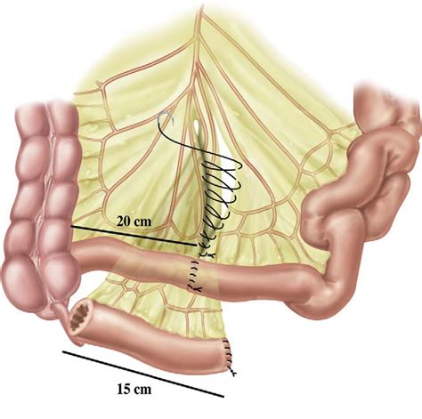 [PDF] Ileal Conduit as the Standard for Urinary Diversion After Radical Cystectomy for Bladder ...