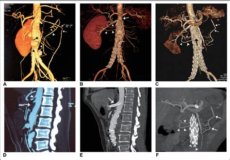 Celiac Artery Stenting in the Treatment of Intestinal Ischemia Due to the Sacrifice of the ...