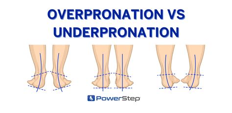 What is Overpronation vs Underpronation? – PowerStep