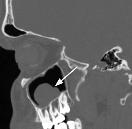 Maxillary Sinus Retention Cyst - slidesharetrick